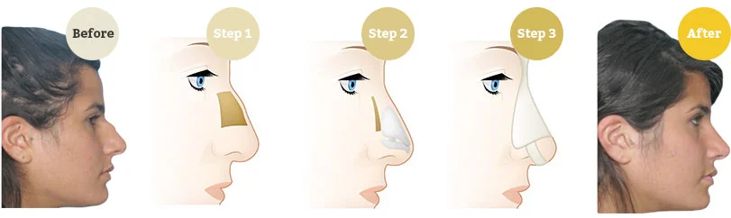 best rhinoplasty clinic in islamabad
