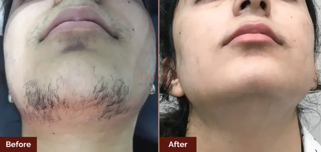 hair removal laser near me