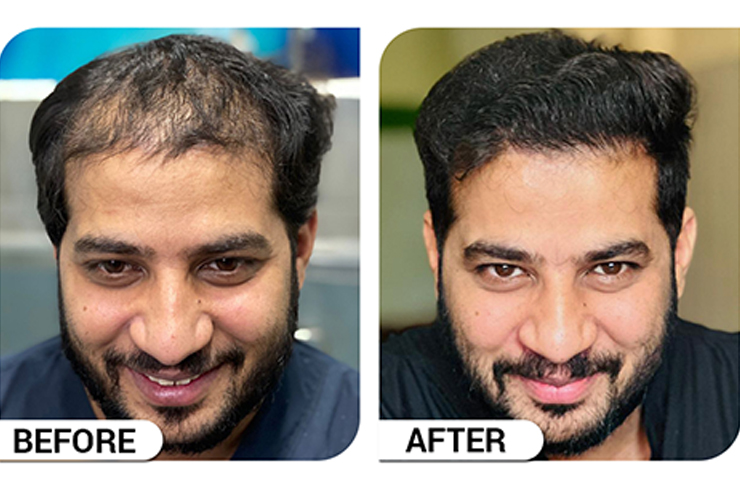 Exosomes Therapy in Islamabad Before & After at ritual aestehtic clinic