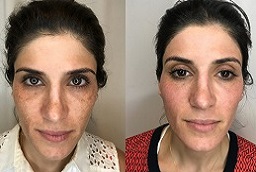 pico laser before and after