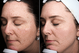 pico lasser treatment