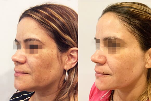 Pico Laser treatment islamabad