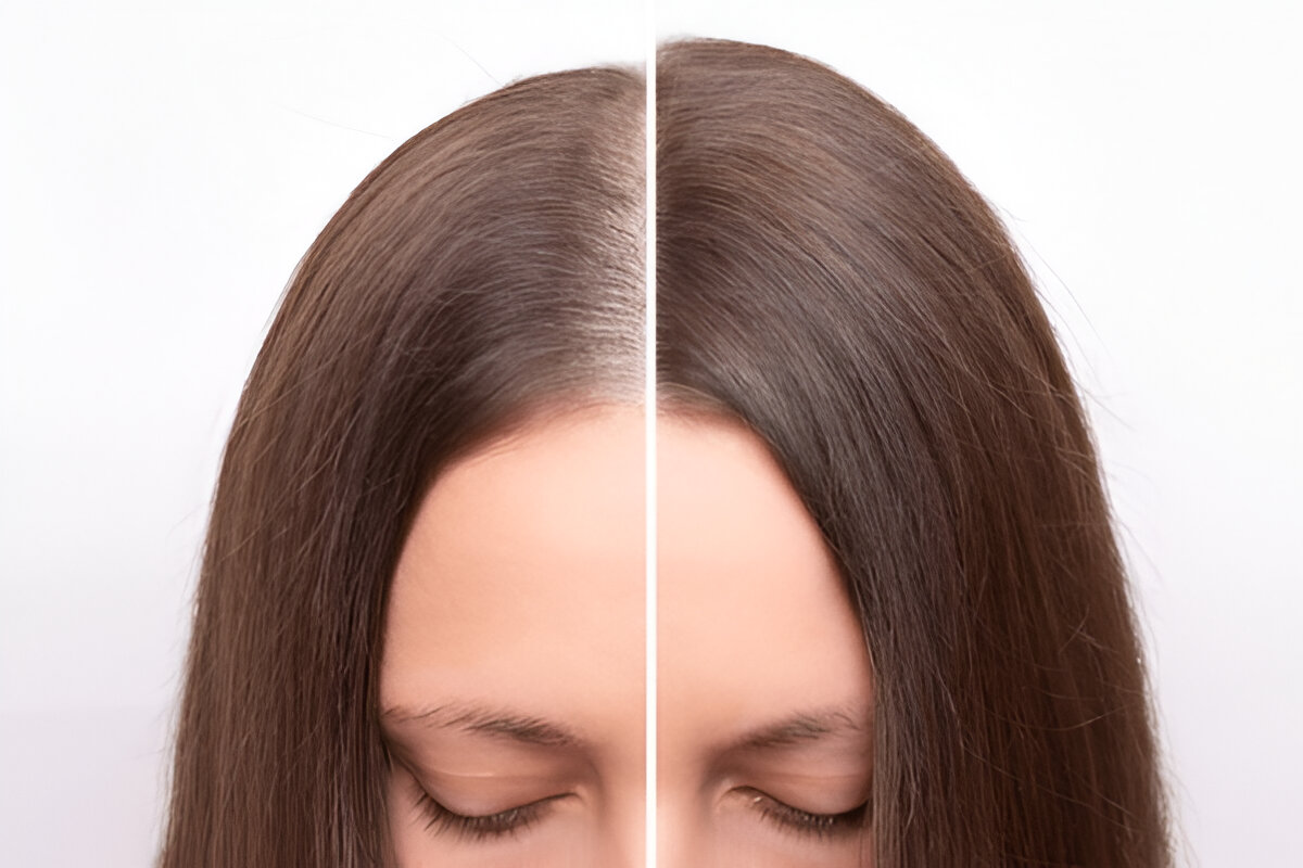 hair fall treatment before after ritual aesthetic clinic